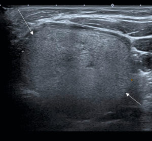 Figure 30.3 Nodules thyroïdiens solides présentant différents risques de malignité. Coupe transversale du lobe thyroïdien gauche montrant un nodule de 40 mm hyperéchogène homogène, classé EU-TIRAD® 3, à faible risque de malignité.