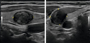 Figure 30.4 Coupes longitudinale (A) et transversale (B) du lobe thyroïdien droit montrant un nodule de 14 mm de grand axe fortement hypoéchogène. Ce nodule est classé EU-TIRAD® 5, à risque élevé de malignité.