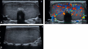 Figure 30.5 Goitre chez une enfant de 14 ans, suivie pour une maladie de Basedow. Coupe transversale (A) sur la thyroïde montrant les deux lobes et l'isthme, augmentés de taille et de parenchyme discrètement hétérogène. Sur la coupe longitudinale du lobe thyroïdien droit (B), les bords de la thyroïde sont globuleux (flèche). En doppler couleur (C), la glande est globalement hypervascularisée.