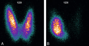 Figure 30.6 Hyperthyroïdie, scintigraphie à l'123I. A. Hyperfixation diffuse en rapport avec une maladie de Basedow. B. Hyperfixation focale en rapport avec un adénome toxique.