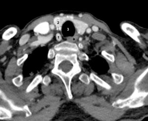 Figure 30.7 Coupe TDM axiale après injection d'un adénome parathyroïdien inférieur droit (1) ; thyroïde (2), trachée (3).