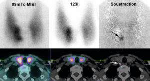 Figure 30.8 Hyperparathyroïdie primaire, scintigraphie par méthode de soustraction. Après soustraction sur les images planaires et tomoscintigraphiques, il existe un foyer parathyroïdien unique en position eutopique.