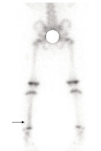 Figure 31.10 Chez un enfant de 18 mois boitant depuis une semaine, visibilité sur le cliché scintigraphique en incidence postérieure sur les membres inférieurs, 2 heures après l'injection d'un diphosphonate marqué au 99mTc, d'une hyperfixation des deux tiers inférieurs de la diaphyse tibiale gauche (flèche noire). C'est l'aspect scintigraphique très évocateur de fracture en cheveu. Plus la fracture est récente, plus l'hyperfixation est intense.