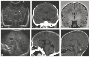 Figure 31.11 Comparaison des différentes techniques d'imagerie pour l'exploration du cerveau chez le nouveau-né. L'échographie (A, B) permet de visualiser le parenchyme cérébral et les ventricules (flèches blanches), mais les régions pariétales et la fosse postérieure sont mal identifiées. En TDM (C, D), la voûte du crâne et les espaces péricérébraux sont bien explorés (flèches grises). En IRM, sur une séquence pondérée en T1 avec inversion récupération (E), la différenciation substance blanche-substance grise, et sur une séquence pondérée en T1 (F), la fosse postérieure avec le vermis (flèche blanche en pointillés), le tronc cérébral et la tente du cervelet (têtes de flèche) sont bien identifiés.