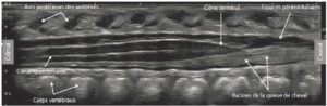Figure 31.12 Échographie médullaire chez un nouveau-né de 15 jours dans le plan sagittal montrant le contenu du canal vertébral à l'étage dorsolombaire.
