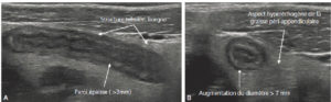 Figure 31.13 Échographie abdominale d'une appendicite aiguë non compliquée chez un enfant de 14 ans avec une coupe longitudinale (A) et axiale de l'appendice (B).