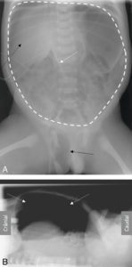 Figure 31.14 Pneumopéritoine chez un nouveau-né prématuré en position couchée sur une radiographie d'abdomen de face (A) et de profil avec rayon horizontal (B). Pneumopéritoine visible en A sous la forme d'une hyperclarté pré-hépatique (flèche noire en pointillés), d'une clarté centrale (contourée par la ligne blanche en pointillés) moulant le ligament falciforme (flèche blanche) associée à la présence d'air dans le scrotum (flèche noire). Le pneumopéritoine est visible en B sous la forme d'un croissant gazeux sous la paroi abdominale (flèches blanches en pointillés).