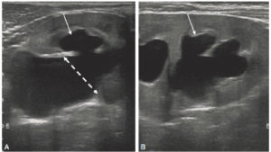 Figure 31.17 Échographie rénale en coupes axiale (A) et longitudinale (B) montrant une dilatation pyélocalicielle. Le pyélon est dilaté (double flèche en pointillés) sur la coupe axiale centrée sur le hile du rein. Les calices sont également dilatés (flèches blanches).