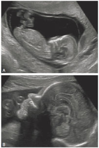 Figure 31.19 Échographie anténatale chez un fœtus à 12 SA (A) et 31 SA (B) montrant une coupe sagittale médiane de l'ensemble du fœtus à 12 SA et de la face fœtale à 31 SA. On note qu'à 31 SA, les structures cérébrales sont bien visibles, comme en échographie transfontanellaire en postnatal (voir figure 31.11).