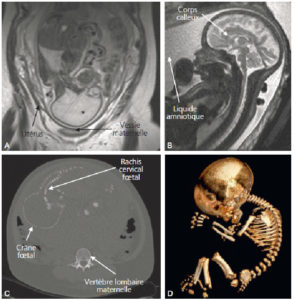 Figure 31.20 IRM (A, B) et TDM (C, D) fœtales. Coupe de repérage en IRM montrant l'ensemble du fœtus tête (astérisque) en bas dans l'utérus (A) et coupe sagittale en pondération T2 centrée sur la ligne médiane cérébrale du fœtus (B) (on note un bras en coupe axiale devant les lèvres du fœtus). En TDM, sur les coupes en 2D (C), le squelette fœtal est visible, un peu moins dense que le squelette maternel (vertèbre lombaire) et il est possible de réaliser des reconstructions en 3D de l'ensemble du squelette fœtal, ici dans le cadre d'une suspicion d'achondroplasie (D).