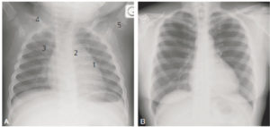 Figure 31.21 Cinq différences entre la radiographie thoracique d'un nourrisson (A) et celle d'un adulte (B). Outre l'incidence antéropostérieure responsable d'un certain agrandissement, les différences sont : 1. présence du thymus ; 2. non-visibilité de la crosse aortique ; 3. portion antérieure du gril costal entièrement cartilagineuse, donc non visible sur la radiographie ; 4. courbure claviculaire accentuée du fait de la position des bras au-dessus de la tête ; 5. présence du point d'ossification huméral supérieur.