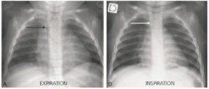 Figure 31.22 Déviation trachéale physiologique vers la droite chez un nourrisson de 20 mois sur une radiographie de thorax réalisée en expiration (flèche noire) (A). Sur le cliché en inspiration, la trachée redevient rectiligne (flèche blanche) (B).