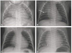 Figure 31.23 Aspects radiographiques normaux du thymus. Aspect ondulé des bords du thymus sur un cliché réalisé en expiration (flèche noire) (A) ; aspect en voile latine (flèche blanche) (B) ; extension du thymus jusqu'à la coupole diaphragmatique (flèche noire en pointillés) (C) ; fausse impression de cardiomégalie du fait de l'extension inférieure du thymus (flèches blanches en pointillés) (D).