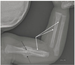 Figure 31.3 Radiographie de l'humérus et de l'avant-bras gauches de profil chez une enfant de 2 ans montrant des fractures multiples dans un contexte de traumatisme non accidentel. Il existe une fracture du tiers moyen de la diaphyse humérale gauche (flèche noire) avec un cal osseux (flèche noire en pointillés) et des appositions périostées (flèches blanches) au niveau de l'humérus et du radius.