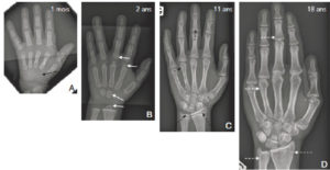 Figure 31.4 Ossification progressive du carpe et des épiphyses métacarpo-phalangiennes sur des radiographies de la main et du poignet gauches de face chez un nourrisson de 1 mois (A), un enfant de 2 ans (B), un adolescent de 11 ans (C) et un adulte de 18 ans (D). À la naissance, le carpe n'est jamais ossifié : la maquette cartilagineuse est de tonalité hydrique et n'est donc pas visible directement sur une radiographie (flèche noire). Progressivement, le carpe et les épiphyses vont s'ossifier à partir des noyaux d'ossification (flèches blanches). Le cartilage de croissance reste radiotransparent tant que la croissance n'est pas terminée (flèches noires en pointillés). La fermeture du cartilage de croissance signe la fin de la croissance (flèches blanches en pointillés).