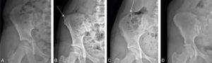 Figure 31.5 Méthode d'évaluation de l'âge osseux chez l'adolescent : radiographie de l'aile iliaque pour le test de Risser. Le point iliaque n'est pas ossifié chez une fille de 10 ans : Risser 0 (A). Le point d'ossification est visible sur le versant latéral de l'aile iliaque chez une adolescente de 12 ans : Risser 1 (flèche) (B). Le point d'ossification se prolonge sur le versant médial de l'aile iliaque chez une adolescente de 13 ans : Risser 4 (C). Il est enfin complètement fusionné chez une adolescente de 16 ans : Risser 5 (D), signant la fin de la croissance.