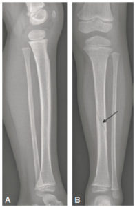 Figure 31.6 Radiographies de la jambe gauche chez une enfant de 3 ans montrant l'intérêt de réaliser deux incidences orthogonales. La fracture spiroïde de la diaphyse tibiale est difficile à discerner sur le cliché de profil (A), alors qu'elle est parfaitement visible sur le cliché de face (B) (flèche).