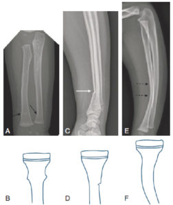 Figure 31.7 Radiographies et représentation schématique des fractures spécifiques de l'enfant. A, B. Fracture en motte de beurre métaphysodiaphysaire distale du radius et de l'ulna droits chez un nourrisson de 18 mois (flèches noires). C, D. Fracture en bois vert diaphysaire distale du radius chez un enfant de 14 ans (flèche blanche). E, F. Fracture plastique du radius, sans luxation de la tête radiale, chez un enfant de 4 ans (flèches en pointillés).