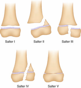 Figure 31.8 Classification de Salter et Harris des fractures épiphysométaphysaires. Source : Skirven TM, Osterman AL, Fedorczyk J, et al. (Eds.). Rehabilitation of the Hand and Upper Extremity, 2-Volume Set, Seventh Edition. © Elsevier 2021.