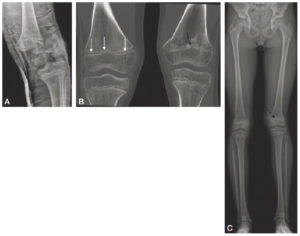 Figure 31.9 Fracture passant par le cartilage de croissance. Sur la radiographie réalisée le jour du traumatisme chez un enfant de 11 ans (A), mise en évidence d'une fracture passant par le cartilage de croissance fémoral distal gauche avec déplacement important. Sur la TDM réalisée chez le même enfant un an après la fracture (B, reconstructions en coupe coronale des deux genoux) : à droite, le cartilage de croissance fémoral distal est normal (flèches blanches) ; à gauche : visibilité d'un pont d'épiphysiodèse (flèche noire). Sur la radiographie des deux membres inférieurs réalisée en position debout 2 ans après le traumatisme (C) : fermeture prématurée du cartilage de croissance fémoral distal gauche (flèche en pointillés) et inégalité de longueur des membres avec un raccourcissement du fémur gauche.