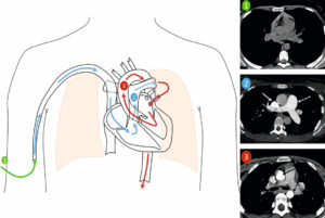 Figure 4.10 Progression du bolus de produit de contraste dans les vaisseaux thoraciques. Le bolus de contraste suit le sens physiologique de la circulation sanguine. En 1, acquisition sans injection sur les gros vaisseaux thoraciques. Le produit est injecté par une veine du membre supérieur droit. En 2, le produit rejoint la veine cave supérieure (flèche blanche) et opacifie l'atrium droit puis le ventricule droit (non montrés) puis il opacifie l'artère pulmonaire et ses branches (flèche blanche en pointillés). Il passe ensuite dans la circulation pulmonaire puis les veines pulmonaires avant d'opacifier l'atrium et le ventricule gauches. En 3, le produit est éjecté dans l'aorte thoracique ascendante (flèche noire) et descendante (flèche noire en pointillés). Chaque étape correspond à une nouvelle acquisition qui suit la circulation du produit de contraste dans les structures vasculaires. Dessin : Eléonore Blondiaux.