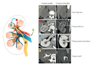 Figure 4.11 Rehaussement parenchymateux : exemple du rein. En 1 : acquisition sans injection de produit de contraste. En 2 : à partir de l'aorte, le produit de contraste se distribue aux branches artérielles aortiques : l'artère rénale est opacifiée (flèche blanche) et dans le même temps le cortex rénal (flèche blanche en pointillés). En 3 : le rehaussement parenchymateux (cortex + médullaire) s'effectue selon un délai variable d'un organe à l'autre (flèche noire), le retour veineux s'effectue par la veine rénale (flèche noire en pointillés) et se collecte finalement dans le système cave inférieur. En 4 : l'élimination du produit de contraste est principalement rénale, ce qui permet d'obtenir une opacification des calices et de l'uretère (pointes de flèche). Dessin : Eléonore Blondiaux.