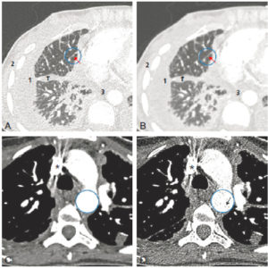 Figure 4.3 Angio-TDM thoracique réalisée chez une patiente souffrant d'une néoplasie mammaire évoluée (coupes axiales). A. Reconstruction en filtre dur affichée en fenêtre parenchymateuse pulmonaire. Le filtre dur autorise une bonne résolution spatiale permettant de bien mettre en évidence les épaississements des lignes septales comportant de petites formations micronodulaires (flèche) dans le cadre de cette lymphangite carcinomateuse. Le contraste spontané avec l'air étant élevé, une fenêtre large est utilisée. En revanche, le faible contraste de cette fenêtre ne permet pas la distinction entre l'épanchement pleural (1) ou sa composante scissurale (1′), le muscle dentelé antérieur (2) et la graisse médiastinale (3). B. Même coupe qu'en A reconstruite en filtre mou et affichée en fenêtre parenchymateuse pulmonaire. Le filtre mou diminue le bruit au sein de l'image au détriment de la résolution spatiale, rendant moins évidente la composante micronodulaire au sein de l'épaississement septal (flèche). L'amélioration du rapport S/B par ce filtre ne permet néanmoins pas d'améliorer la différenciation entre les structures hydriques, musculaires et graisseuses (1 à 3) qui dépend du fenêtrage. C. Autre plan de coupe avec reconstruction en filtre mou affichée en fenêtre médiastinale. Le filtre mou offre un rapport S/B meilleur (zone agrandie au sein du cercle), permettant de bien étudier les structures tissulaires ou vasculaires. Noter la présence d'artefacts de durcissement du faisceau (atténuation des photons de basse énergie, laissant une forte proportion de photons de haute énergie) autour de la veine cave supérieure et liée au bolus de produit de contraste très dense (astérisque). D. Même coupe qu'en C reconstruite en filtre dur et affichée en fenêtre médiastinale. Bien qu'affichée en fenêtre médiastinale, l'étude du médiastin et des vaisseaux n'est pas optimale car le rapport S/B est faible. Le bruit davantage présent dans l'image se manifeste sous la forme d'un aspect granuleux visible (flèche au sein de la zone agrandie).