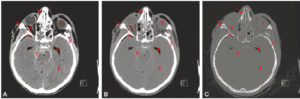 Figure 4.4 TDM cérébrale sans injection réalisée dans le cadre d'un traumatisme craniofacial sévère (même coupe axiale reconstruite selon différents filtres en utilisant différents fenêtrages). 1. Corps vitré de l'œil gauche (densité hydrique : 0 UH) ; 2. graisse rétro-orbitaire (densité graisseuse : –80 UH) ; 3. écaille temporale (densité osseuse : 950 UH) ; 4. air au sein de la corne temporale du ventricule latéral gauche (densité aérique : –980 UH) ; 5. sang au sein de la citerne prépontique (densité hématique : 65 UH) ; 6. parenchyme cérébral (densité tissulaire : 30 UH). A. Reconstruction en filtre mou affichée en fenêtre parenchymateuse cérébrale. Le fenêtrage permet la bonne visibilité de l'hémorragie sous-arachnoïdienne traumatique diffuse moulant les sillons corticaux et les citernes droites (5) ainsi que la différenciation entre les substances blanche et grise (6). La pneumencéphalie (astérisque) en temporopolaire droit est également bien visible et signe la présence d'au moins une fracture. B. Reconstruction en filtre mou affichée dans une fenêtre proche d'une fenêtre parenchymateuse pulmonaire. Cette fenêtre est plus large que la précédente, diminuant ainsi le contraste. L'hémorragie est nettement moins visible (5) et la distinction entre les substances blanche et grise n'est plus possible (6), la rendant inappropriée pour l'étude du parenchyme cérébral. La nuance entre les densités graisseuse (2) et aérique (4) est mieux visible qu'en A. C. Reconstruction en filtre dur affichée en fenêtre osseuse. Cette fenêtre est centrée sur les densités plus élevées et est large. Le contraste naturel entre l'os cortical et les autres structures ne nécessite pas une fenêtre étroite (3). Le filtre dur augmente par ailleurs la résolution spatiale, rendant ainsi visibles les fins traits de fracture du processus frontal de l'os zygomatique droit et des os nasaux (flèches). Ces fractures ne sont pas décelables sur les reconstructions en filtre mou, d'autant plus qu'elles ne sont pas affichées en fenêtre osseuse.