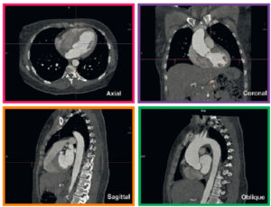 Figure 4.5 MPR d'une angio-TDM thoracique. Le mode MPR permet l'affichage d'une même série d'images natives dans les plans axial (cadre rose), coronal (cadre violet) et sagittal (cadre orange) de manière simultanée ou dans tout autre plan de l'espace. Ici, une reconstruction sagittale oblique dans le plan de la crosse aortique permet d'afficher le vaisseau sur toute sa longueur (cadre vert).