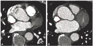 Figure 4.6 Angio-TDM thoracique réalisée dans le cadre d'une suspicion de dissection aortique (coupes axiales). A. Les battements cardiaques se répercutent sur la racine aortique et sont responsables d'artefacts cinétiques se manifestant sous la forme d'un dédoublement des contours, mimant ainsi une dissection de l'aorte thoracique ascendante (flèches noires). Noter la présence d'une embolie pulmonaire (défaut de rehaussement endoluminal ; flèches blanches). B. Le recours à une synchronisation cardiaque (« gating » cardiaque) permet de s'affranchir des artefacts cinétiques et d'écarter ici le diagnostic de dissection aortique. La synchronisation cardiaque n'est pas toujours possible dans le cadre de l'urgence, ce qui n'empêche habituellement pas le diagnostic (en particulier lorsque la dissection atteint l'aorte descendante, fixe et donc moins sensible aux artefacts cinétiques). A, B. Le bolus de produit de contraste concentré au sein de la veine cave supérieure est responsable d'artefacts de durcissement du faisceau, se manifestant par des bandes hypodenses (astérisque).