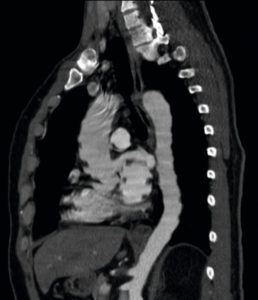 Figure 4.7 Angio-TDM thoracique réalisée dans le cadre d'une suspicion de dissection aortique (coupe sagittale oblique). L'absence de synchronisation cardiaque et une résolution temporelle insuffisante (temps de rotation du rotor trop long) génèrent des artefacts de mouvement avec un aspect crénelé de l'aorte thoracique qui gêne son évaluation.