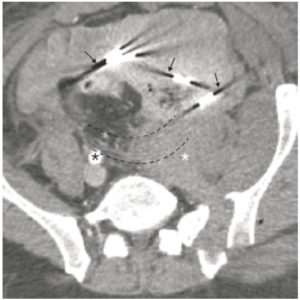 Figure 4.8 TDM abdominopelvienne en coupe axiale à l'étage pelvien. L'examen est réalisé dans le cadre d'un traumatisme grave du bassin ayant nécessité le tamponnement d'un saignement par des compresses après laparotomie puis fermeture (cette technique d'hémostase chirurgicale en urgence est également appelée packing). Les compresses présentent des bandes métalliques permettant leur repérage radiographique ou comme ici en TDM. Ces bandes sont responsables d'artefacts métalliques (flèches noires). Par ailleurs, il existe probablement un problème de calibration sur le scanographe ayant réalisé l'examen, se manifestant sous la forme de bandes disposées en cible (lignes pointillées). Noter la thrombose de l'artère iliaque primitive gauche qui n'est pas opacifiée (astérisque blanc), contrairement à son homologue controlatérale (astérisque noir).