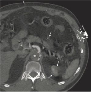 Figure 4.9 Dissection aortique sur TDM thoraco-abdomino-pelvienne (coupe axiale à l'étage abdominal). La vitesse d'avancée de table élevée utilisée est responsable d'artefacts en hélice au pôle supérieur du rein gauche, ou en étoiles en regard des structures vasculaires, propres à la technique hélicoïdale (flèches). Les électrodes du scope ECG posées sur la peau sont responsables d'artefacts métalliques (doubles flèches). Noter l'opacification du vrai chenal (astérisque noir), tandis que le faux chenal, circulant plus lentement, n'est pas encore opacifié (astérisque blanc).