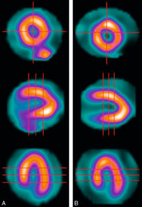 Figure 5.6 Tomoscintigraphie de perfusion myocardique chez un patient au repos. Coupes petit axe (haut), grand axe verticale (milieu) et grand axe horizontale (bas) acquises en 18 minutes sur une gamma-caméra conventionnelle NaI (A). Mêmes coupes acquises en 4 minutes sur une gamma-caméra CdZnTe cardiologique General Electric (B). Source : avec l'aimable autorisation du Dr Gimelli, Fondazione Toscana/CNR G. Monasterio, Pise, Italie.