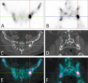 Figure 5.7 Tomoscintigraphie osseuse acquise sur une caméra hybride gamma-caméra/TDM chez un patient présentant des métastases de cancer de la prostate. La tomoscintigraphie dans les plans axial (A) et coronal (B) révèle plusieurs foyers d'hyperfixation osseuse au niveau du bassin. La TDM acquise dans les mêmes plans retrouve des lésions condensantes en regard de ces foyers (C, D). La fusion des deux modalités conforte le diagnostic de métastases osseuses (E, F). Source : Université Paris-Saclay/CEA-SHFJ, Orsay, France.