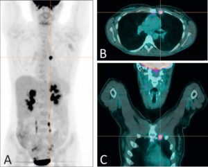 Figure 5.8 TEP au 18F-FDG chez une patiente présentant une atteinte métastatique de cancer du sein. La représentation en mode maximum intensity projection (A) permet une visualisation de tous les sites d'accumulation du 18F-FDG ; outre les sites physiologiques (cerveau, reins, urètres, vessie), la TEP révèle un foyer hypermétabolique pathologique au niveau thoracique. La fusion avec la TDM dans les plans axial (B) et coronal (C) permet d'attribuer ce foyer à une métastase lymphatique mammaire interne gauche. Source : Université Paris-Saclay/CEA-SHFJ, Orsay, France.