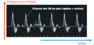 Figure 7.12 Analyse de spectre d'un signal Doppler, ici obtenu sur une artère fémorale. Le temps est en abscisse, les fréquences positives ou négatives en ordonnée et l'échelle de gris montre la puissance du signal Doppler pour chaque pixel. L'hémodynamique est bien restituée en termes de fluctuation temporelle des vitesses. GR : globules rouges.