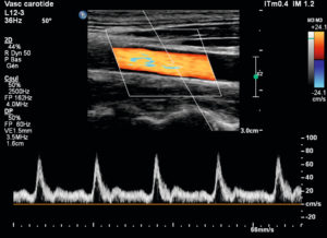 Figure 7.13 Aspect habituel d'une image associant les modes B, imagerie Doppler et spectre du Doppler pulsé. Le signal Doppler pulsé a été recueilli dans la fenêtre de mesure au centre de l'artère carotide commune encodée ici en rouge orangé. L'écoulement se fait de la droite vers la gauche de l'image, donc en situation de rapprochement de la sonde. Le codage en bleu au centre correspond pour quelques pixels à un artefact de sous-échantillonnage.