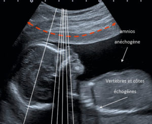 Figure 7.6 Image échographique et représentation schématique des lignes d'acquisition (lignes blanches) ayant effectué le balayage figuré par la double flèche rouge. L'image obtenue (coupe sagittale d'un fœtus) correspond à l'ensemble de ce qui a été balayé par les tirs ultrasonores.