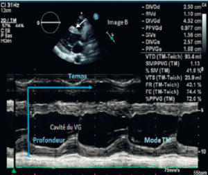 Figure 7.7 Sur cette copie d'écran, on voit en haut une image mode B du cœur qui a servi à positionner la ligne du mode TM (flèche). Le résultat apparaît en bas, le temps en abscisse et la profondeur en ordonnée. Ce mode permet de mesurer notamment l'épaisseur des parois et le diamètre de la cavité ventriculaire gauche en systole et en diastole.