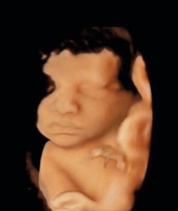 Figure 7.8 Technologie 3D, extraction de la surface cutanée in utero d'un fœtus (âge gestationnel : 35 semaines d'aménorrhée).