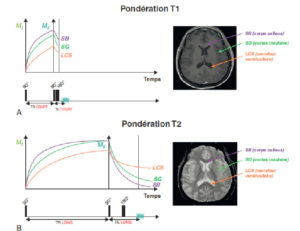 Figure 8.19 Influence des séquences pondérées T1 et T2 sur le contraste au sein du système nerveux central. A. En séquence T1 (TR court pour pondérer T1 et TE court pour limiter la pondération T2), le contraste est anatomique : la substance blanche est blanche, la substance grise est grise et le LCS est hypo-intense. B. En séquence T2 (TR long pour limiter la pondération T1 et TE long pour pondérer T2), le contraste est inversé : la substance blanche est plus hypo-intense que la substance grise et le LCS est hyperintense. La majorité des phénomènes pathologiques s'accompagnent d'une augmentation du contenu en eau, ce qui augmente les temps de relaxation T1 et T2 et ce qui apparaît donc en hyposignal sur les séquences pondérées T1 et en hypersignal sur les séquences pondérées T2 (figure 8.20A). Certaines modifications pathologiques impactent différemment les temps de relaxation. Par exemple, un saignement au bout de quelques jours (stade de méthémoglobine) va raccourcir le T1 et le T2, ce qui apparaît donc en hypersignal sur les séquences pondérées T1 et en hyposignal sur les séquences pondérées T2 (figure 8.20B). L'hyposignal sera encore plus marqué sur les séquences T2*, dans lesquelles on ne corrige pas les inhomogénéités de B0 comme expliqué précédemment.