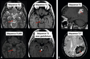 Figure 8.20 Exemples de modifications du signal induites par des conditions pathologiques au sein de l'encéphale. A. Abcès mésencéphalique. L'abcès, visualisé après injection de gadolinium (tête de flèche), est entouré d'œdème apparaissant en hypersignal T2 et FLAIR et en hyposignal T1 (flèches) car cette augmentation du contenu en eau allonge les temps de relaxation T1 (relaxation plus lente, d'où hyposignal) et T2 (décroissance plus lente, d'où hypersignal). B. Hématome subaigu. La présence de sang au stade de méthémoglobine (flèche pointillée) raccourcit les temps de relaxation T1 (récupération plus rapide, d'où hypersignal) et T2 (décroissance plus rapide, d'où hyposignal).