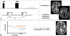 Figure 8.22 Principe de la séquence de diffusion. A. Deux impulsions de gradient de diffusion sont appliquées de façon symétrique par rapport à l'impulsion de 180° d'une séquence T2. Ces impulsions induisent une chute de signal sur l'image résultante d'autant plus importante que l'eau est plus mobile. En bleu : parenchyme sain ; eau à mobilité normale = chute de signal. En orange : infarctus cérébral ; eau à mobilité restreinte (œdème intracellulaire) = peu de chute de signal. Noter que l'infarctus cérébral n'est pas visible sur la séquence T2 sans les impulsions de gradient de diffusion car la quantité d'eau n'est pas augmentée, mais le déficit énergétique induit par l'infarctus entraîne un transfert d'eau du milieu interstitiel vers le milieu intracellulaire où sa mobilité est plus restreinte. B. Le coefficient apparent de diffusion (ADC) quantifie la chute de signal en diffusion de manière absolue. En bleu : parenchyme sain ; chute de signal = ADC élevé. En orange : infarctus cérébral ; chute faible de signal = ADC bas.