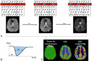 Figure 8.24 Principe de la séquence de perfusion. A. Six voxels sont schématisés dont certains sont traversés par un vaisseau (proportions non respectées). Les vecteurs d'aimantation se déphasent lors de l'arrivée du gadolinium (chute du signal en T2 au sein des vaisseaux). Le déphasage induit par le gadolinium se propage aux voxels voisins, même si le gadolinium reste intravasculaire, ce qui accentue la chute du signal en T2. B. Courbe de variation de signal en fonction du temps de passage d'un bolus de gadolinium. Sont représentés, le temps au pic (TAP), le temps de transit moyen (TTM) et l'aire sous la courbe (bleue) qui représente le volume sanguin cérébral (VSC). C. Cartes paramétriques sur lesquelles les valeurs quantitatives issues de l'analyse des courbes de premier passage sont représentées voxel par voxel sur une échelle couleur, DSC étant le débit sanguin cérébral.