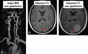 Figure 8.25 Exemples d'utilisation de chélates de gadolinium. A. Angio-IRM des troncs supra-aortiques et des artères du cercle artériel du cerveau (polygone de Willis) après injection de gadolinium. B. Méningiome pariétal gauche (flèche) se rehaussant fortement après injection de gadolinium.